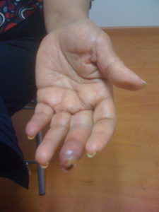 Vasculitis en dedo Indice